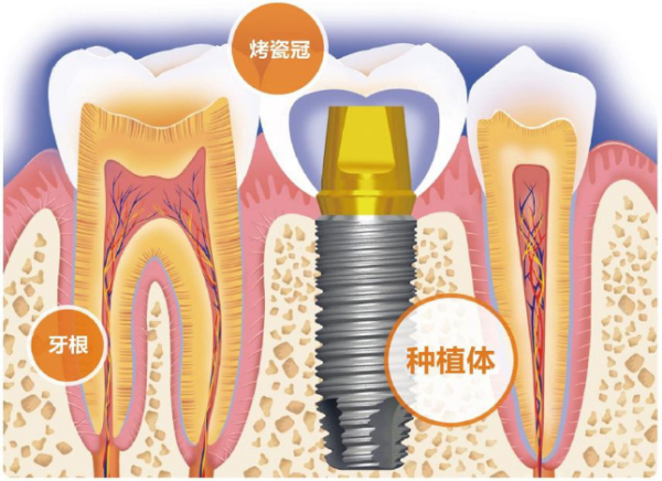 为什么要选择种植牙？