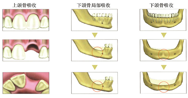 (牙槽骨吸收示意图)