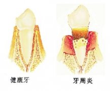 乳牙也会发生牙周炎