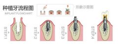 重庆牙科医院做种植牙需要多长时间?