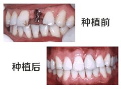 介绍即刻种植牙比普通种植牙有哪些优势