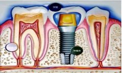 种植牙对个人口腔条件和牙周条件的要求